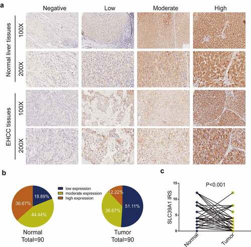 Figure 1. SLC39A1 expression in EHCC tissues and normal liver tissues. (a) Staining of SLC39A1 was evaluated by an immunoreactivity score (IRS) by multiplying the intensity score with the score of percentage of positive cells. Representative microphotographs represented low, moderate and high staining intensity in EHCC tissues and normal tissues. Brown, SLC39A1. Blue, hematoxylin. (b) SLC39A1 protein expression intensity proportion of EHCC tissues and paired normal tissues. Low expression: IRS<4; Moderate expression: 4≤ IRS<8; High expression: IRS≥8. (c) The expression of SLC39A1 protein in EHCC tissues and paired normal tissues. A significant decrease of SLC39A1 expression was observed in EHCC tissues compared with paired normal tissues