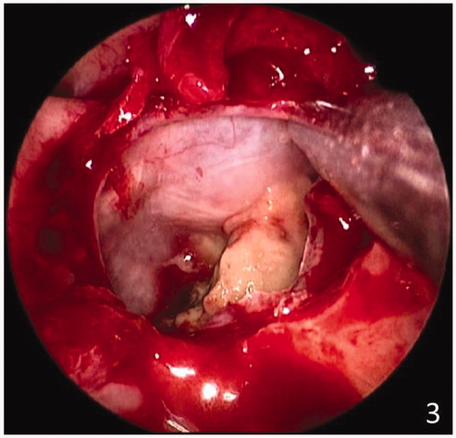 Figure 3. Intraoperative Endoscopic view of the sphenoid sinus after marsupialisation of the sphenoidal mucocele.