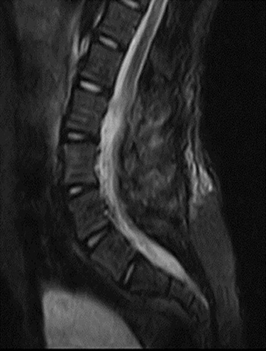 Figure 3 Postoperative control lumbosacral MRI demonstrating complete tumor excision.