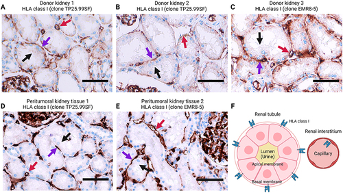Figure 7 Location of HLA class I on the kidney biopsies. (A – E) HLA class I immunohistochemistry on kidney tissue obtained from discarded donor kidneys (A – C) and peritumoral kidney tissue (D – E). Two HLA class I antibodies are used. Black arrows point out the apical membrane of renal tubules, and purple arrows indicate their basal membrane side. Red arrows present vessels in the renal interstitium. (F) A cartoon illustrating the HLA class I location in the renal tubule and interstitium. Created with BioRender.com.