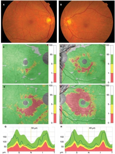 Figure 1 Fundus photographs and results of measurement of the macular GCC and cpRNFL obtained from Case 1.