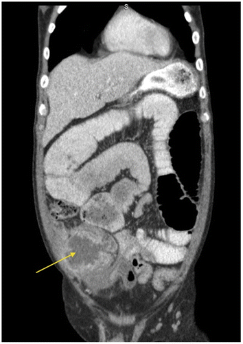 Figure 6d: Coronal CT showing marked small bowel obstruction secondary to a tumour in the right iliac fossa (arrow)