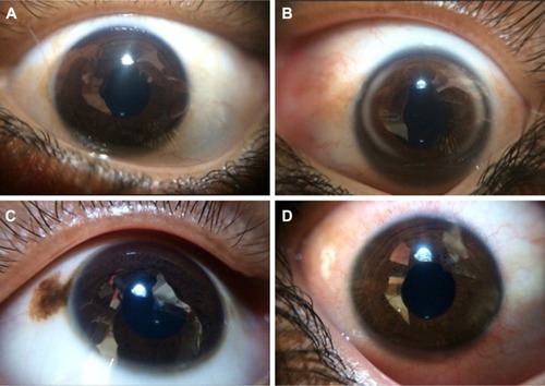 Figure 2 Photographs of the ocular surface taken by using the EyeGo adapter for anterior segment imaging. Reflections present due to suboptimal lighting conditions.