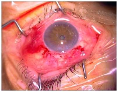 Figure 3 Eye appearance after surgery; releasable suture is visible.