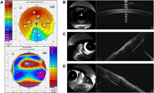 Figure 3 Corneal topography before wearing scleral lenses as measured with Pentacam (A) and OCT illustrating good central clearance (B), edge assessment of nasal (C) and temporal location (D) in case 2. The blue arrow on the left means the central blue line of OCT cross section in the right photo.