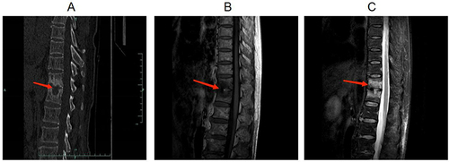 Figure 2 CT and MRI results of thoracolumbar vertebrae on the second day of hospitalization. (A): CT testing showed destruction of the T11 and T12 vertebral bodies. (B): MRI testing showed infectious lesions in T11-12 vertebral body and the right appendage of T12 (T1 weighted imaging signal was down). (C): MRI testing showed infectious lesions in T11-12 vertebral body and the right appendage of T12 (T2 weighted imaging signal was high). The red arrow showed the destruction of the T11 and T12 vertebral bodies.
