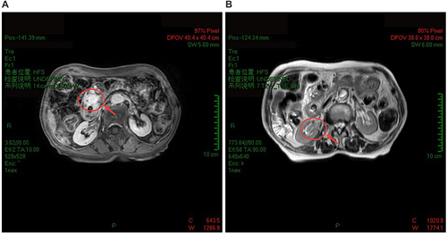 Figure 3 Gadolinium-enhanced total abdomen MRI images with lesions in the pancreas and renal pelvis on November 7th, 2022. The lesion located in uncinate process of head of pancreas still showed gradual enhancement on T1-weighted images (A, red circle and arrow). Lesion (MD = 2.2 cm) in the right renal pelvis showed slightly higher signal on T2-weighted image (B, red circle and arrow).