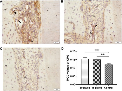 Figure 10 Expression of OPG in the compression side of distopalatal root of maxillary molar.