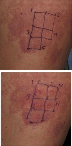 Figure 3 A previously untreated capillary malformation (port-wine stain) at the right thigh.