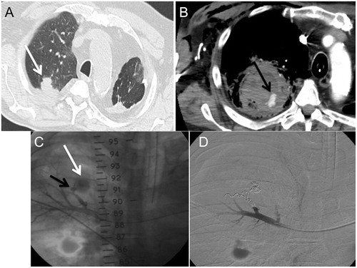Figure 2. Occurrence of a lung adenocarcinoma in an 80-year-old patient. (A) CT, axial slice (parenchymal window) showing the right apical 26-mm lesion before PRFA (arrow). Massive haemoptysis occurred 24 h after lung PRFA. (B) CT axial slice (mediastinal window). Contrast-enhanced CT scan showed a haematoma adjacent to the ablative zone. A pulmonary artery P was observed in the haematoma (arrow). (C) Pulmonary arteriography confirmed the apparition of a PA in the lower right lobe pulmonary artery (black arrow) associated with an active extravasation of contrast (white arrow). (D) Angiography: pulmonary arteriography immediately after coil embolisation. Coils were placed into and proximal to the PA. The PA was excluded.
