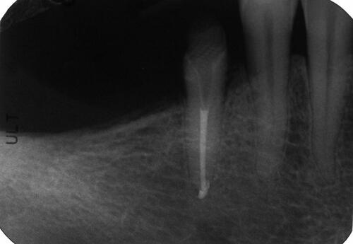 Figure 6 Postoperative periapical radiography, the endodontic retreatment was performed, and the post and core have been luted.