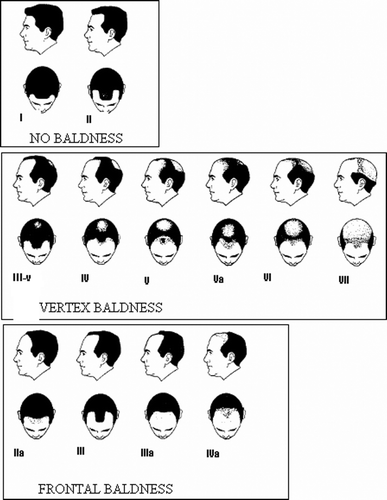 Figure 1. HS of baldness hair patterns as proposed by Norwood and arranged according to no baldness, vertex baldness and frontal baldness.