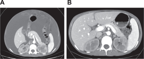 Figure 2 A) Contrast-enhanced CT of abdomen revealed massive ascites. B) Contrast-enhanced CT taken after modified hemodialysis for 10 days. The scan at the same level as (A) reveals the disappearance of ascites.