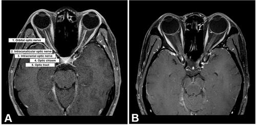 Figure 1 (A) Each AVP scan was composed of five segments: orbital optic nerve, intracanalicular optic nerve, intracranial optic nerve, optic chiasm and optic tract. (B) Fat-suppressed T1-weighted with gadolinium contrast axial MRI showing enhancement of optic chiasm (arrow) and optic tract (arrowhead).