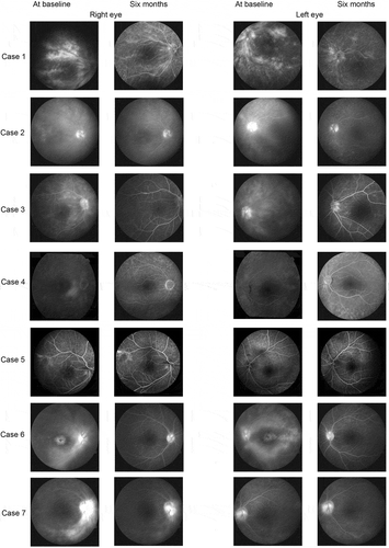 Figure 2. The two left columns show the fluorescein angiography of the right eye per case at baseline and after 6 months of treatment. The two right columns show the fluorescein angiography of the left eye per case at baseline and after 6 months of treatment