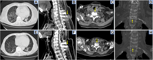 Figure 3 CT findings. 2016–3 chest CT showed multiple patchy exudations, fibrous proliferation and ground glass opacity in both lungs, bronchiectasis in the dorsal segment of the left lower lobe and pleural thickening (A). 2016–3 bone CT showed irregular bone destruction of the lower border of the C7 vertebral body, the upper border of the T1 vertebral body and its spinous process, bone defect of the anterior border of the T1 vertebral body, with surrounding abscess and the narrowing of the C7-T1 intervertebral space (arrows) (B–D). 2017–7 chest CT showed absorption of pulmonary lesions after anti-NTM therapy (E). 2017–7 bone CT shows the repair of bone destruction in C7-T1 vertebral bodies and the disappearance of the surrounding abscess after anti-NTM therapy (arrows) (F–H).