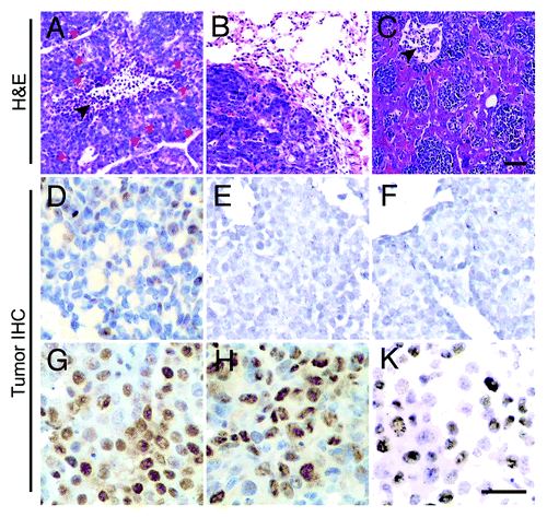 Figure 3. Morphological characteristics of TA2 spontaneous breast cancer. (A) TA2 spontaneous breast cancer is mostly composed of small round cells with few cytoplasms, and they form various tumor nests separated by well-developed stroma. The center of the solid tumor nest show necrosis (black arrow), and several cells are undergoing mitosis (red arrows). (B) TA2 spontaneous breast cancer metastasis in the lung. (C) TA2 spontaneous breast cancer metastasis in the liver. Tumors nest in the sinusoidal vessels of the liver; the black arrow indicates a necrotic area. (D) IHC for ER. Several tumor cells are positive for ER staining. (E) IHC for PR. No tumor cell expressing PR is found. (F) IHC for hEGFR-2. TA2 spontaneous breast cancer is negative for hEGFR-2. (G) IHC for p53. Mild to moderate p53 expression is detected in the tumor cells. (H) IHC for cyclin D1. Cyclin D1 expression is high in the neoplastic epithelial cells, indicating the high proliferative activity of breast cancer. (I) IHC for PCNA. Approximately 50% of the breast cancer cells express PCNA, indicating the high proliferation rate of TA2 breast cancer. Rulers are 100 μm.