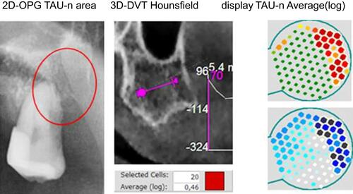 Figure 4 Reduced bone density in HU and TAU-n in the maxillary area 28 corresponding to the area of BMD/AIOJ/FDOJ.