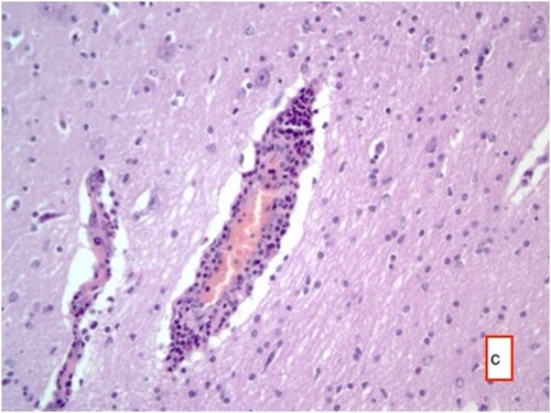 Figure 7. Hyperemia in vessels, perivascular mononuclear cell infiltrates, necrosis in some neurons and gliosis with neuronophagia, HE ×400.