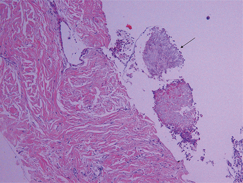 Figure 1 Microscopic view of lung tissue from the upper lobe of the right lung (HE stain, 10*10). A small mass of fungal mycelium-like structure (black arrow) was seen around the lung tissue, with a relatively uniform thickness of the mycelium, which was considered morphologically as an Aspergillus infection.