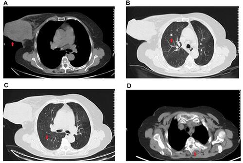 Figure 3 Results of chest computed tomography (CT). (A) The red arrow shows a large breast tumor with thickened skin. (B) The red arrow shows a nodule in the upper lobe of the right lung, indicating lung metastasis. (C) The red arrow shows another nodule in the upper lobe of the right lung, suggesting lung metastasis. (D) The red arrow shows abnormal bone density on the thoracic third vertebral body (T3), indicating bone metastasis.