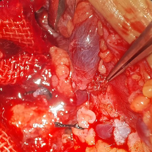 Figure 2 Microvascular anastomosis of the short gastric vein to the left anterior cervical vein to superdrainage.