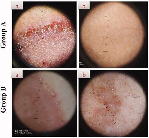 Figure 7. Representative dermoscopic examination of patients receiving F7 (group A) and Miconaz® cream (group B), showing absence of fungal infection in group A. (a, b) Patients before and after treatment, respectively.