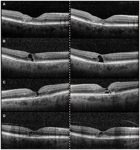 Figure 2 Representative examples of ellipsoid zone (EZ) loss on spectral domain optical coherence tomography (SD-OCT) for untreated (A–B) and Age-Related Eye Disease Study 2 (AREDS2) treated eyes (C–D). SD-OCT images on the right show baseline imaging while the left is from 2-year follow-up. (A) showing an untreated eye at baseline with 20/30−1 visual acuity and an EZ defect of 488 mm. Subsequent 2 years follow-up reveals a worsening EZ defect of 617 mm and stable VA of 20/30−1. (B) depicts an untreated eye with 20/30−2 vision and 262 mm of EZ loss. At 2 years, vision acuity declines to 20/40+2 and EZ loss progressed to 568 mm. (C) is of a AREDS2 treated eye with baseline visual acuity of 20/25+2 and EZ defect of 467, both of which remain relatively similar at 2 years (20/20 and 474 mm). (D) showing an AREDS2 treated eye with 20/30−1 baseline visual acuity and 272 mm EZ loss length. Visual acuity and EZ loss length remain stable at 2 years at 20/30 and 285 mm, respectively.