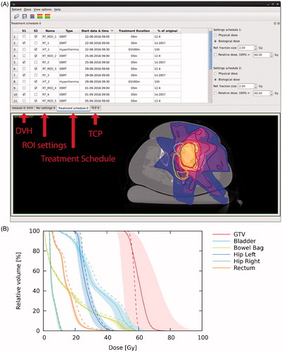 Figure 3. Treatment schedule tab and CT view (A) and DVHs (B) for Example 1. Colour wash (CT view) and dashed lines (DVHs) show the equivalent dose (EQD2) for the conventional 7 × 5 Gy radiotherapy schedule; isodose lines (CT view), solid lines and shaded areas (DVHs) show the equivalent dose (EQD2) for the 7 × 4.34 Gy + 4 × hyperthermia schedule. Shaded areas represent the confidence intervals resulting from uncertainty in biological parameters. For a colour version of this figure, see the online version of this paper.
