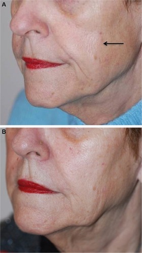 Figure 2 Subject 1 before treatment (A) and 48 months (B) after injection of CPM HA volumizing gel.