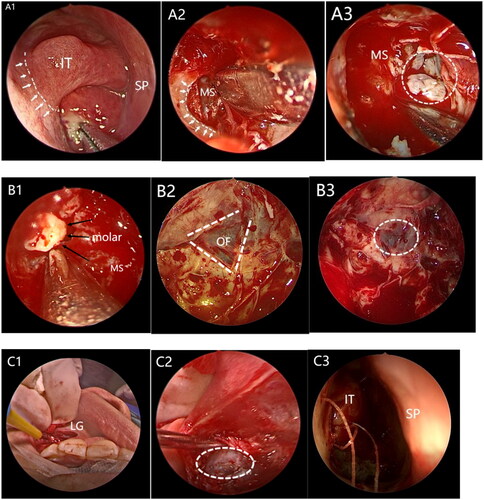 Figure 3. (A) Transnasal endoscopic right anterior lacrimal saphenous approach. A1: The white dashed line shows the curved incision at the anterior edge of the inferior turbinate head by the anterior lacrimal saphenous approach. A2: grinding drill to grind away the bone of the inner wall of the maxillary sinus from anterior to posterior. A3: Greyish-white papillary neoplasm in the maxillary sinus. (B) Excision of maxillary sinus mass + opening of the right inferior nasal tract. B1: a molar located in the posterosuperior wall of the maxillary sinus and encased in a greyish-white neoplasm. B2: After exfoliation of the swelling, the bone of the orbital floor wall was seen to be significantly thinned, and the blue-purple orbital tissue could have peered through the bone wall with the perichondrium intact and bluish. B3: a few bony defects in the posterior external wall of the maxillary sinus, with the dura mater of the inferior temporal fossa visible. (C) Endoscopic transtibial gingival sulcus section Lu’s approach. C1: an approximately 3-cm-long incision in the right labiogingival sulcus. C2: Biting forceps to remove part of the bone of the anterior maxillary sinus wall until the floor wall of the maxillary sinus and the mass are completely exposed. C3: closure of the anterior aspect of the inferior turbinate and the lateral wall of the nasal cavity with 6-0 sutures. IT: inferior turbinate; SP: nasal septum; MS: maxillary sinus; LG: labiogingival groove; OF: orbital floor.
