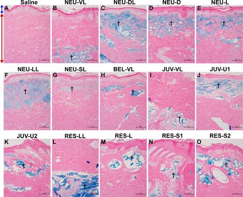 Figure 4 Alcian blue staining at 1 and 4 weeks after intradermal injection of the saline control (A), NEU series (B–G), BEL-VL (H), JUV series (I–K), and RES series (L–O). The NEU and BEL fillers were distributed evenly throughout the dermis as large homogeneous pools of HA material, whereas the JUV and RES fillers tended to agglomerate into smaller pools. Arrows indicate the location of the epidermis (blue) and dermis (red). Daggers indicate the presence of an amorphous basophilic substance (the injected HA gel) stained in blue. All images are shown at the same magnification (× 100).