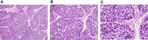 Figure 1 Biopsy specimen for tumor lesions.