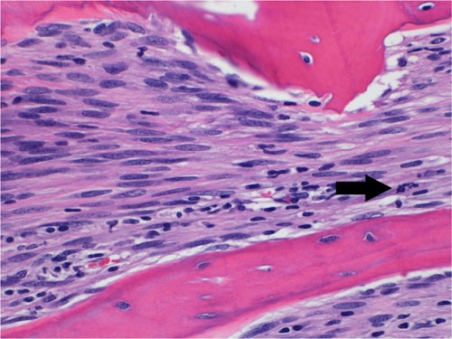 Figure 6 Distal femur final pathology photomicrograph.