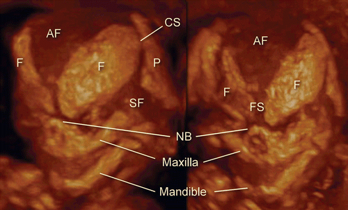Figure 10.  3D maximum mode image of normal craniofacial structure at 14 weeks of gestation. (left) Oblique view. (right) Frontal view. Anterior fontanelle (AF), sphenoidal fontanelle (SF), frontal suture (FS), coronal suture (CS), nasal bone (NB), maxilla and mandible are gradually formed according to cranial bony development.