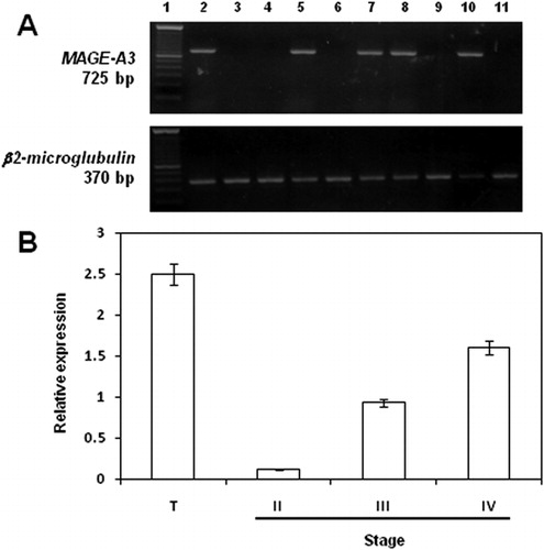 Figure 1. mRNA expression levels of MAGE-A3 in DLBCL stages. (A) Expression of MAGE-A3 in DLBCL. Lane 1, 100-bp ladder; lane 2, testicular tissue; lane 3, PBLs from a healthy donor; lanes 4–11, DLBCL representative samples. (B) Real-time RT-PCR. The expression results were obtained from eight samples from stage II DLBCL patients; nine from stage III and eight from stage IV. Significant differences between results (P<0·05) were obtained by means of parametric test. T, testicular tissue.