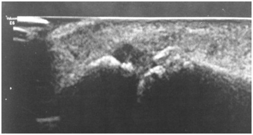 Figure 2. Thumb ultrasound: calcified appearance of MCPL LCL with synovial hypertrophy.