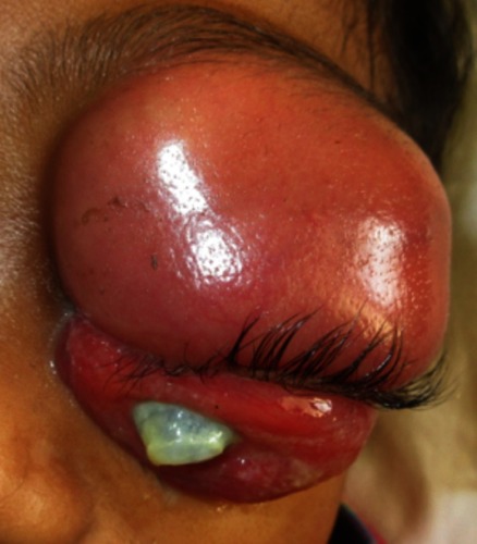 Figure 1 Baseline clinical presentation of left eye shows uniaxial proptosis with marked palpebral edema and conjunctival chemosis. Note the corneal ulcers.