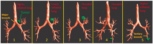 Figure 4. Overview of 3D patient-specific lung bronchi/airway anatomy generated for Models 1–5, each incorporating a distinct tumor geometry/position and lung environment (higher inflated, lower inflated, and flooded lung).