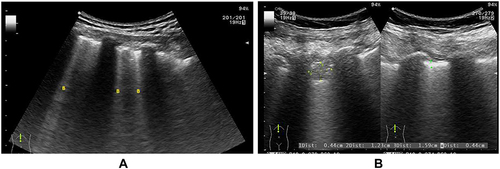 Figure 2 LUS of a patient with COVID-19 with a partially de-aerated lung showing the absence of A-lines, bilateral peripheral multiple spaced (B) B-lines (A), and thick and/or irregular pleural line, subpleural consolidation, and confluent B-line (B).