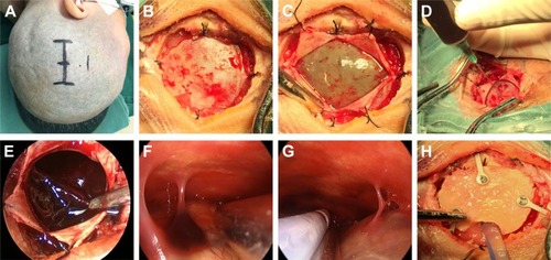 Figure 1 The basic steps of neuroendoscopic hematoma evacuation for chronic and subacute subdural hematoma.