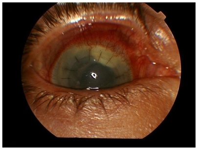 Figure 4 Loculated mass in superior anterior chamber with sclertitis.