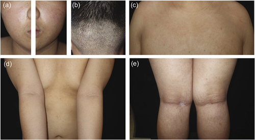 Figure 2 Clinical photographs after 12 weeks of abrocitinib treatment. (a, c-e) The skin manifestations improved significantly, and (b) hair regrowth occurred in the affected area of the scalp.
