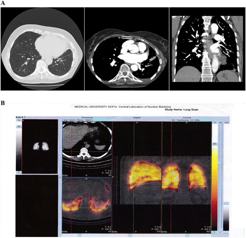Figure 1. CTPA (A) and P-SPECT/CT (B) of Case 1. (A) CTPA of pulmonary artery, main, lobar and segmental branches without visible defects of filling. In the area of left lung lingula parenchyma consolidation and filling defect in the level of subsegmental branches. Small pleural effusion on the left. (B) Perfusion SPECT/CT in the left lung showing perfusion defect in lung lingula with parenchyma consolidation. Small pleural effusion. In the right lung hypoperfusion defects in small branches in lower lobe.