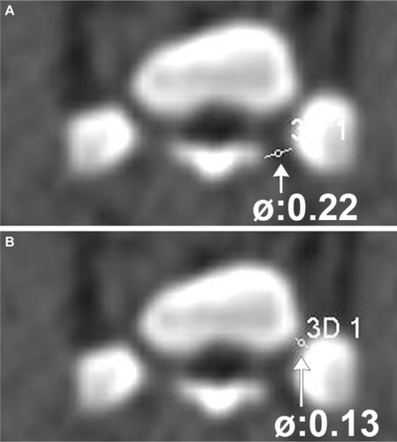 Figure 2 Diameters of the neuroforamen S3 of one selected minipig.