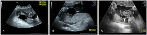 Figure 1. Umbilical cord cysts in different locations as white arrows indicate: A: fetal side; B: placental side; C: free loop of UCC.