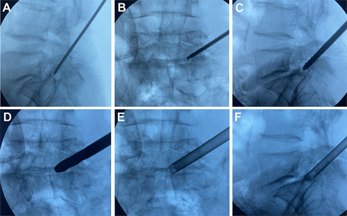 Figure 1 Intraoperative perspective images illustrating the establishment of working channels. Sagittal (A) and anteroposterior (B) fluoroscopic images of the TOM Shidi needle. Employing a 6mm bone drill (C) and 8mm bone drill (D) to remove soft and bony tissues. Anteroposterior (E) and sagittal (F) fluoroscopic images of the working cannula.