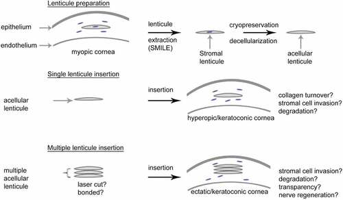 Figure 3. Concept of donor tissue lenticule-based stromal regeneration. Lenticules obtained after small-incision lenticule extraction (SMILE) refractive procedures can be made acellular (and thereby less immunogenic) using procedures such as cryopreservation and chemical decellularization. Cryopreservation additionally enables the long-term storage of lenticules for future use. The acellular lenticules can subsequently be inserted into corneas as an additive therapy to correct for hyperopia (as an alternative to laser ablation) or to flatten and/or thicken the cornea in keratoconus. The long-term stromal regeneration ability of the lenticules, however, as well as their long-term fate after implantation is unknown. In the future, multiple lenticules (typically less than 50 µm thick) could be inserted for example as a stack, into a thin cornea or to replace a portion of scarred or diseased stroma. The regenerative potential of this therapy, and its ability to restore and maintain transparency, however, are unknown.