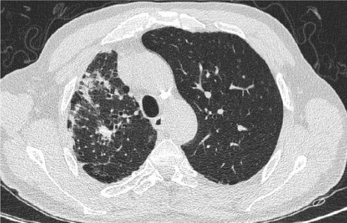 Figure 1 Bronchiectasis in case 1 with TB sequelae in RUL (HRCT).