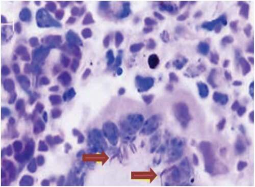 Figure 3. A granulomatous lesion with ZN staining: indicates the presence of giant cells with AFB positive tuberculous bacilli (arrows)